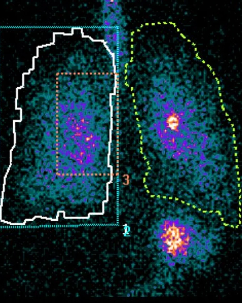 Gamma Scintigraphy Imaging